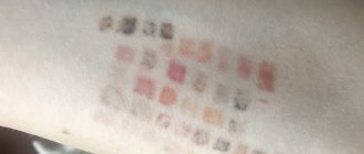 Abtragung mit Laser ohne Remover