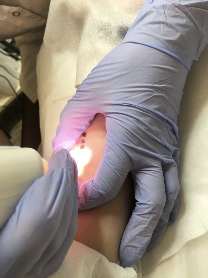 Enlèvement au laser