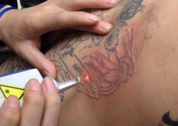 Laseriga eemaldamine