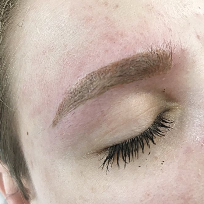 Suppression du pigment par laser. Inversion pigmentaire