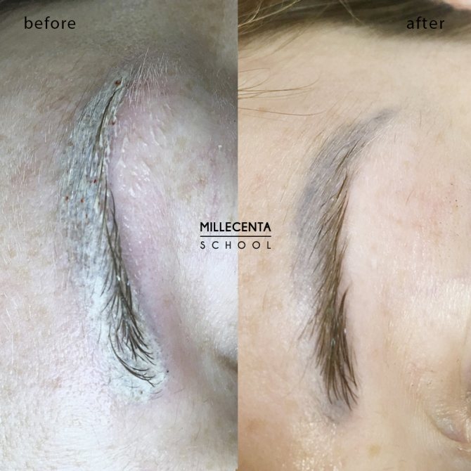 Suppression de la réouverture