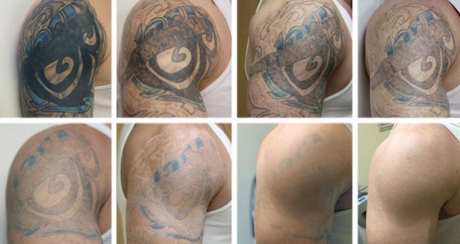 Fjernelse af tatoveringer7