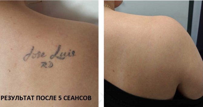 Enlèvement des tatouages au laser