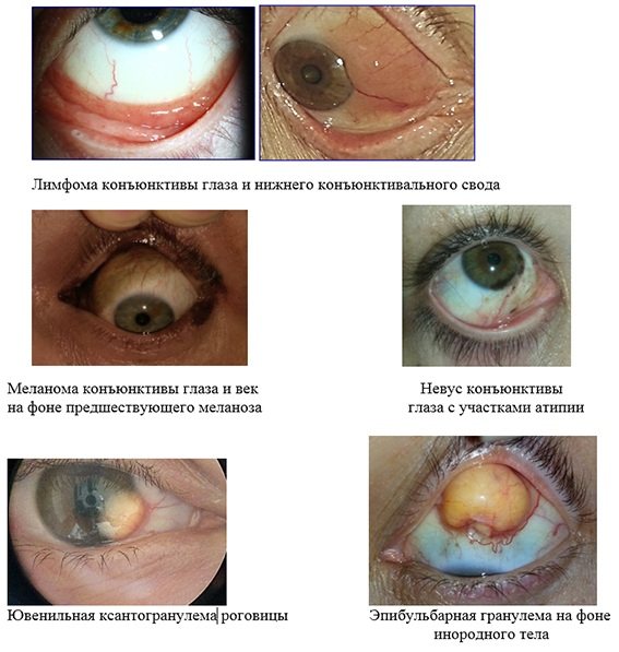 Gelbe Wolfsaugen beim Menschen. Natürliches Foto, Ursachen