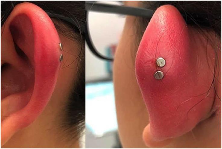 Inflammation après le piercing