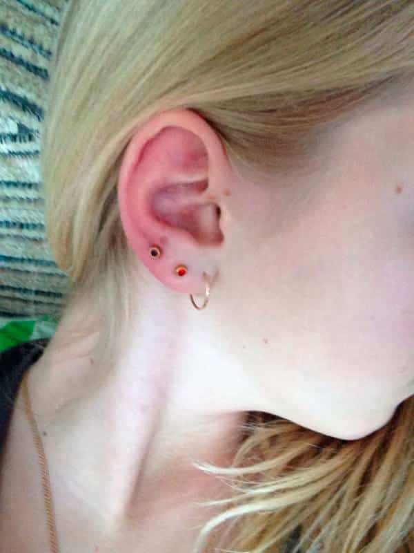 Φλεγμονή του αυτιού μετά το piercing