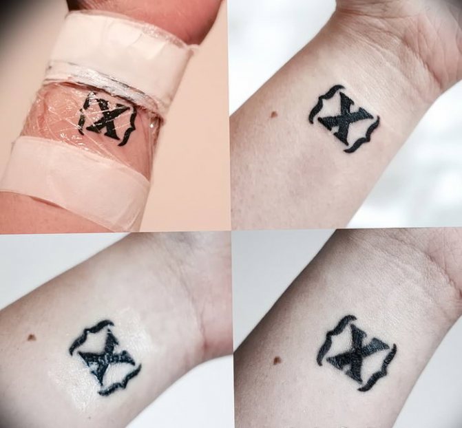 Tatouage enflammé et suppuré. Que faire ?