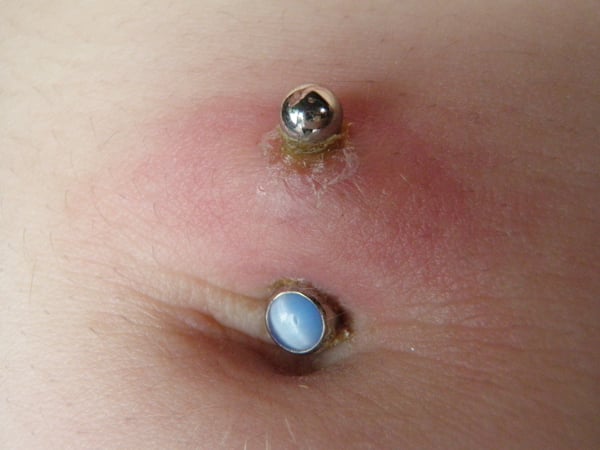 Belly button healing